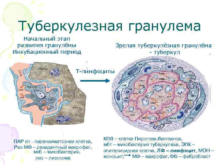  Туберкулезная гранулема  Начальный этап развития гранулёмы    Зрелая туберкулёзная гранулёма