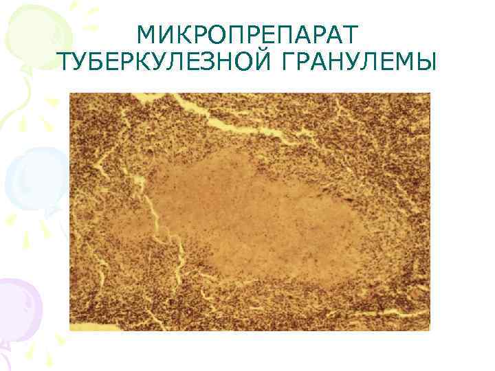  МИКРОПРЕПАРАТ ТУБЕРКУЛЕЗНОЙ ГРАНУЛЕМЫ 