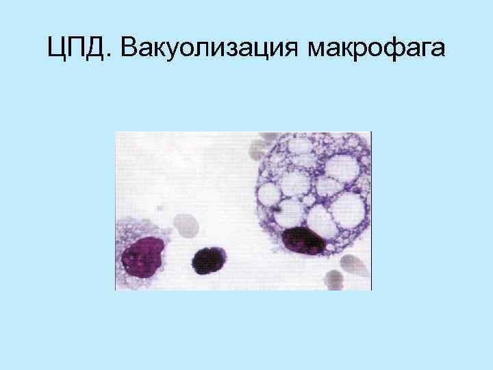 ЦПД. Вакуолизация макрофага 