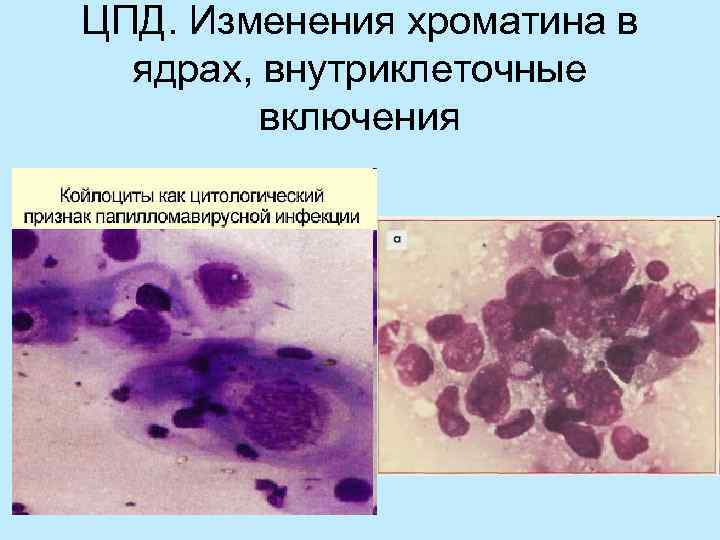 ЦПД. Изменения хроматина в  ядрах, внутриклеточные   включения 