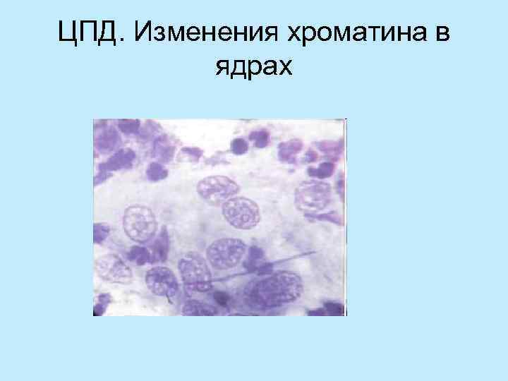 ЦПД. Изменения хроматина в  ядрах 