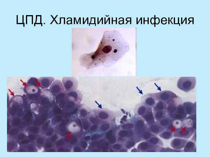ЦПД. Хламидийная инфекция 