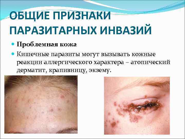 ОБЩИЕ ПРИЗНАКИ ПАРАЗИТАРНЫХ ИНВАЗИЙ  Проблемная кожа  Кишечные паразиты могут вызывать кожные 