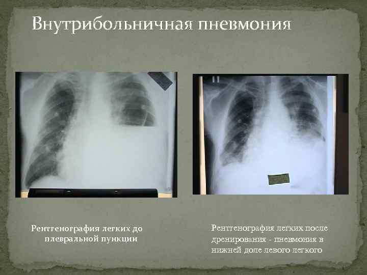 Внутрибольничная пневмония Рентгенография легких до  Рентгенография легких после плевральной пункции дренирования - пневмония