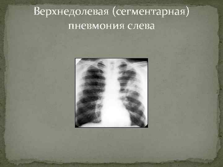 Верхнедолевая (сегментарная)  пневмония слева 