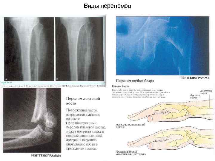 Виды переломов 
