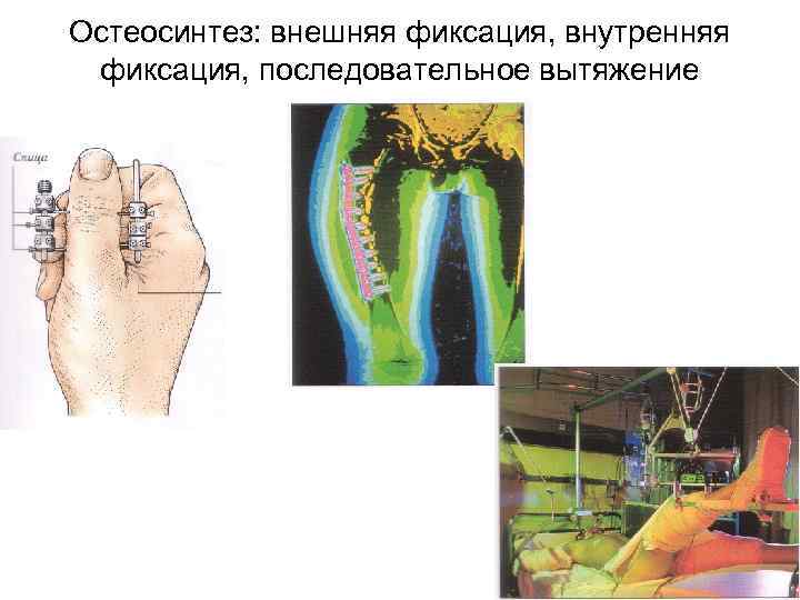 Остеосинтез: внешняя фиксация, внутренняя фиксация, последовательное вытяжение 