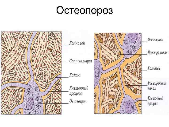 Остеопороз 