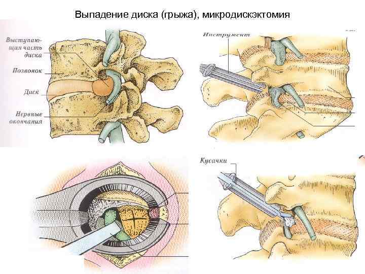 Удаление грыжи позвоночника