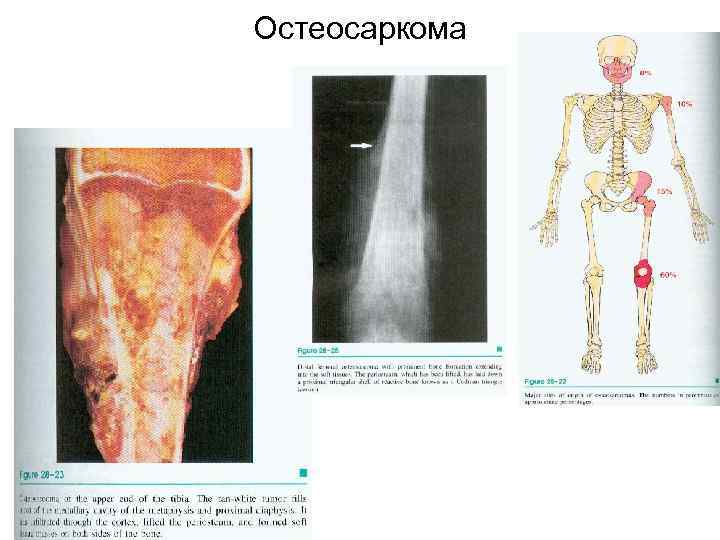 Остеосаркома 