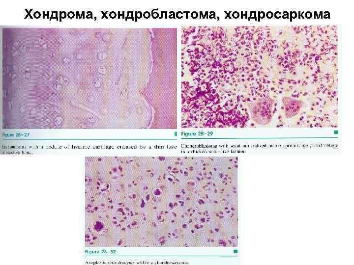 Хондрома, хондробластома, хондросаркома 