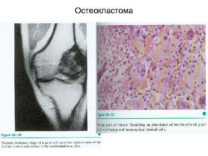 Остеокластома 