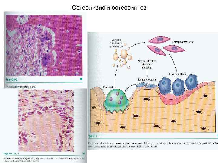 Остеолизис и остеосинтез 