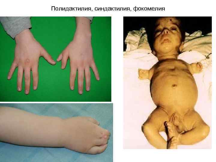 Полидактилия, синдактилия, фокомелия 