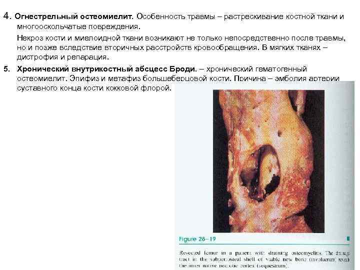 4. Огнестрельный остеомиелит. Особенность травмы – растрескивание костной ткани и многооскольчатые повреждения. Некроз кости