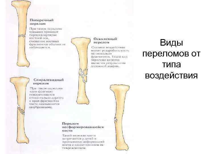 Виды переломов от типа воздействия 