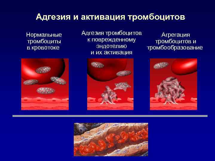 Адгезия и активация тромбоцитов Нормальные тромбоциты в кровотоке Адгезия тромбоцитов Агрегация к поврежденному тромбоцитов