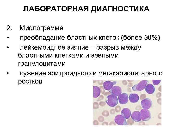ЛАБОРАТОРНАЯ ДИАГНОСТИКА 2. • • • Миелограмма преобладание бластных клеток (более 30%) лейкемоидное зияние