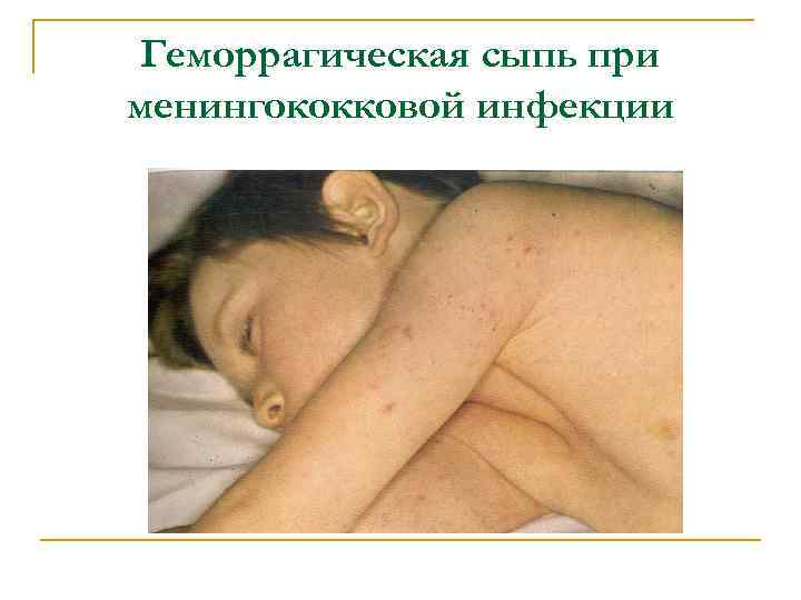 Геморрагическая сыпь при менингококковой инфекции 