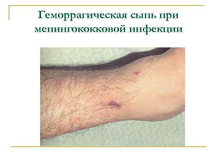 Геморрагическая сыпь при менингококковой инфекции 
