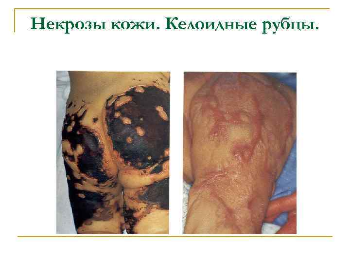 Некрозы кожи. Келоидные рубцы. 
