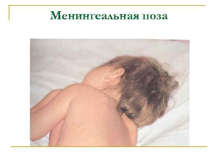 Менингеальная поза 