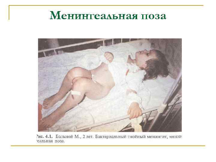 Менингеальная поза 