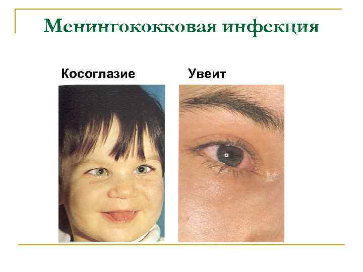 Менингококковая инфекция Косоглазие Увеит 