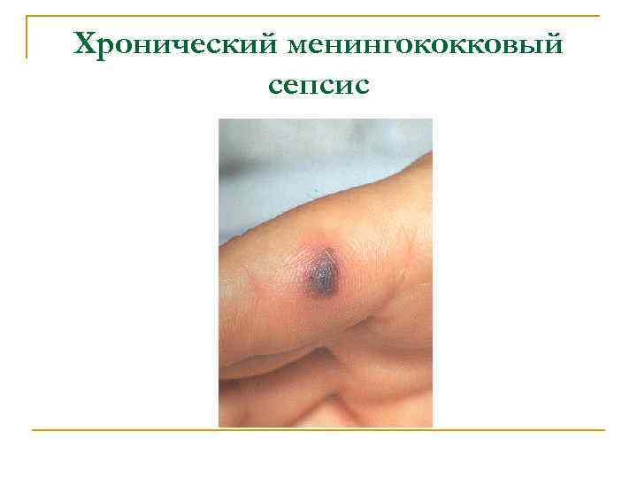 Хронический менингококковый сепсис 