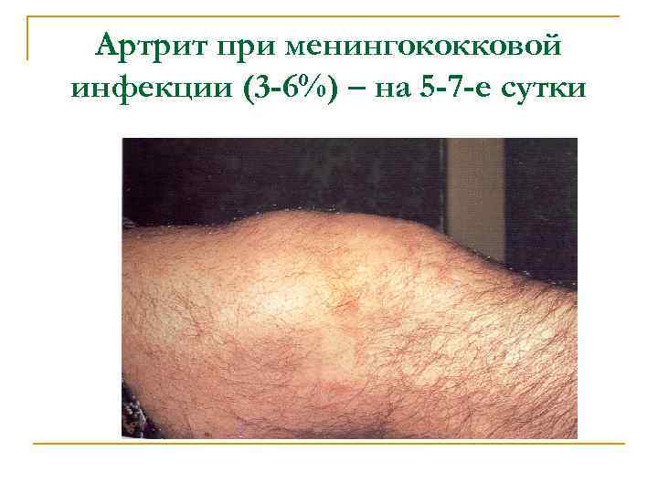 Артрит при менингококковой инфекции (3 -6%) – на 5 -7 -е сутки 