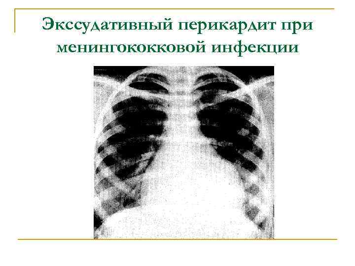 Экссудативный перикардит при менингококковой инфекции 