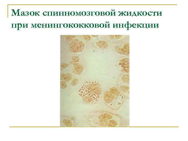 Мазок спинномозговой жидкости при менингококковой инфекции 