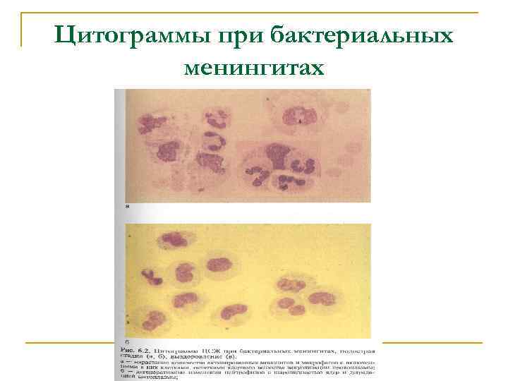 Цитограммы при бактериальных менингитах 