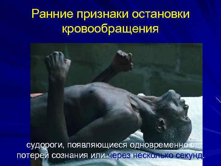 Ранние признаки остановки кровообращения судороги, появляющиеся одновременно с потерей сознания или через несколько секунд.