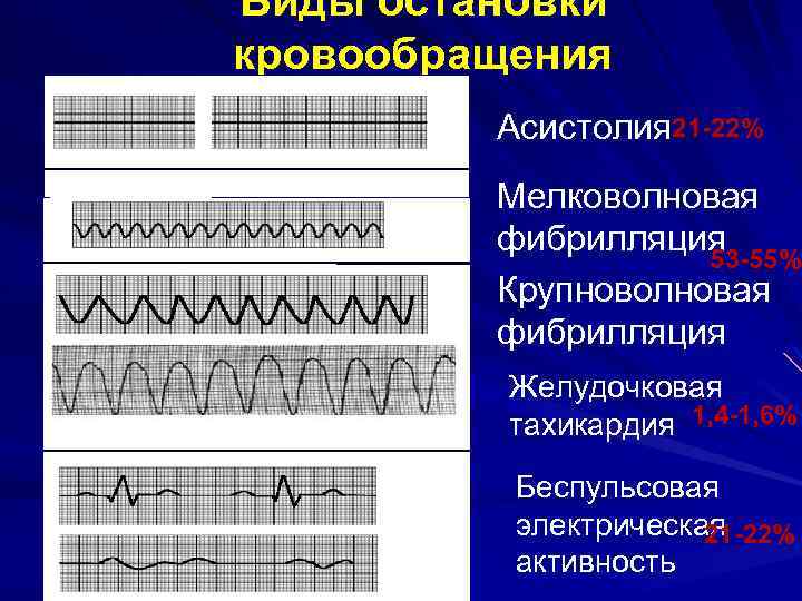 Фибрилляция желудочков фото