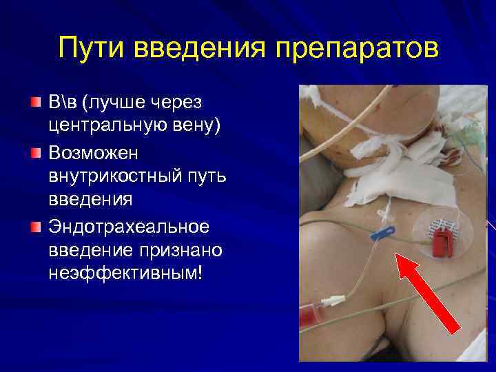 Пути введения препаратов Вв (лучше через центральную вену) Возможен внутрикостный путь введения Эндотрахеальное введение