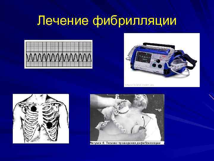 Лечение фибрилляции 