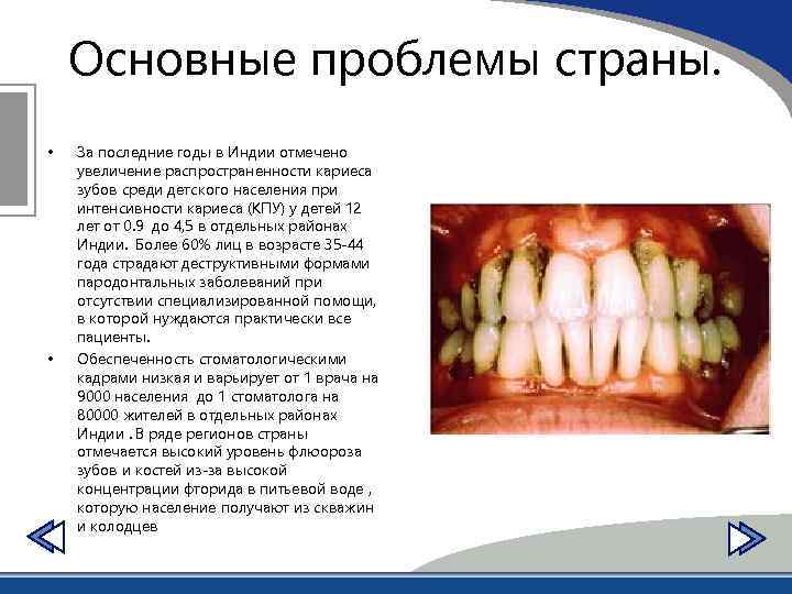 Основные проблемы страны. • • За последние годы в Индии отмечено увеличение распространенности кариеса