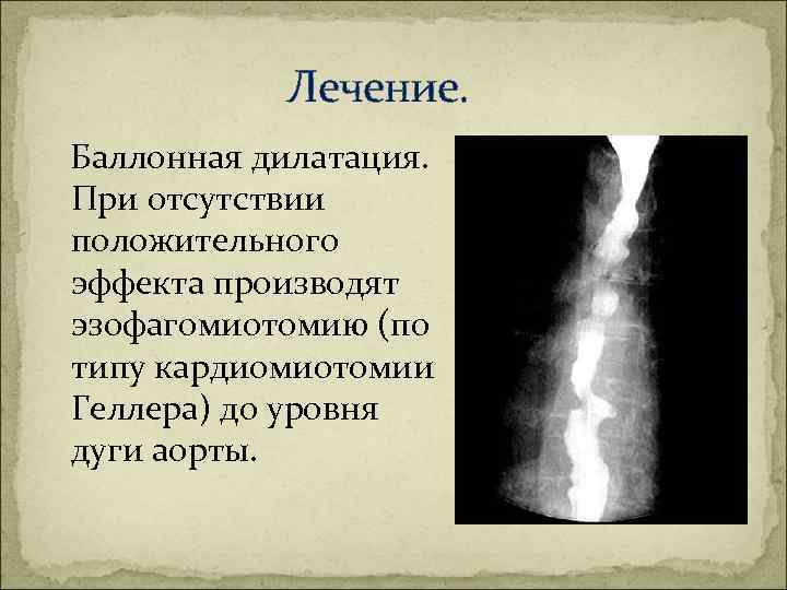 Лечение. Баллонная дилатация. При отсутствии положительного эффекта производят эзофагомиотомию (по типу кардиомиотомии Геллера)