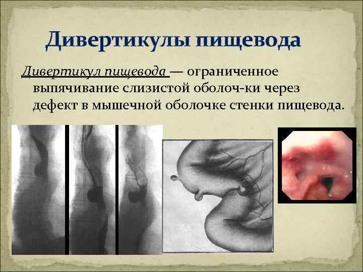 Дивертикулы пищевода Дивертикул пищевода — ограниченное выпячивание слизистой оболоч ки через дефект в мышечной