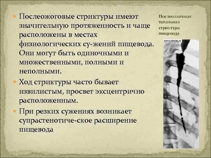  Послеожоговые стриктуры имеют значительную протяженность и чаще расположены в местах физиологических су жений