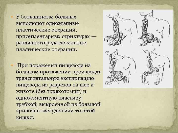 У большинства больных выполняют одноэтапные пластические операции, присегментарных стриктурах — различного рода локальные