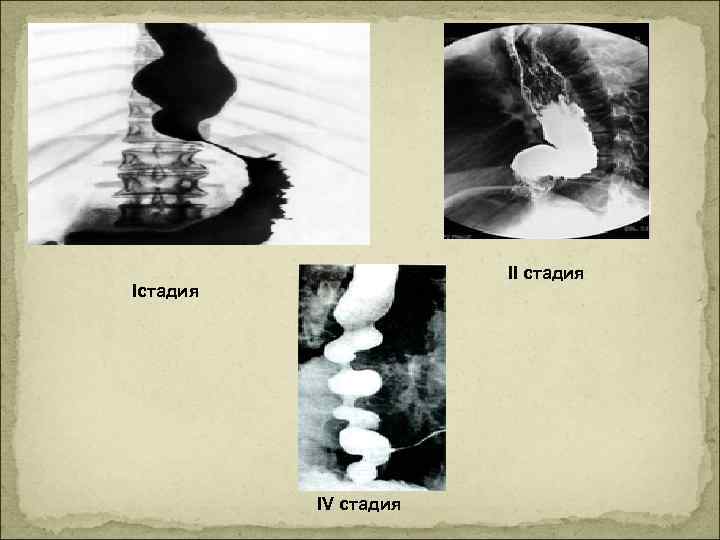 II стадия IV стадия 