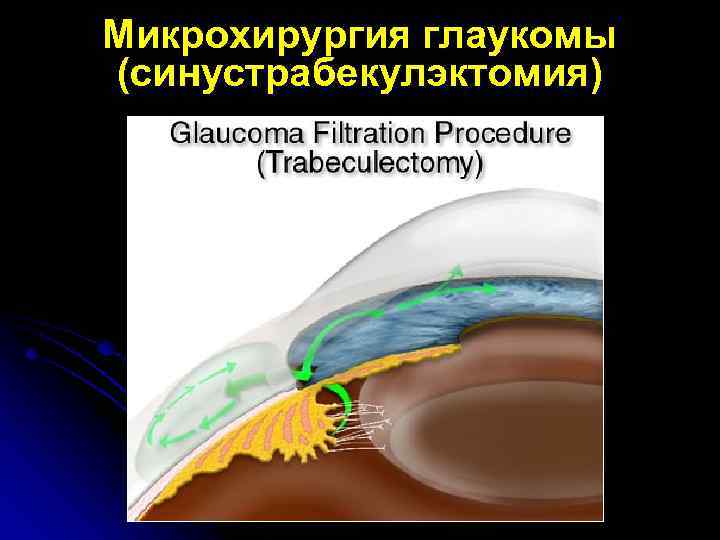 Микрохирургия глаукомы (синустрабекулэктомия) 