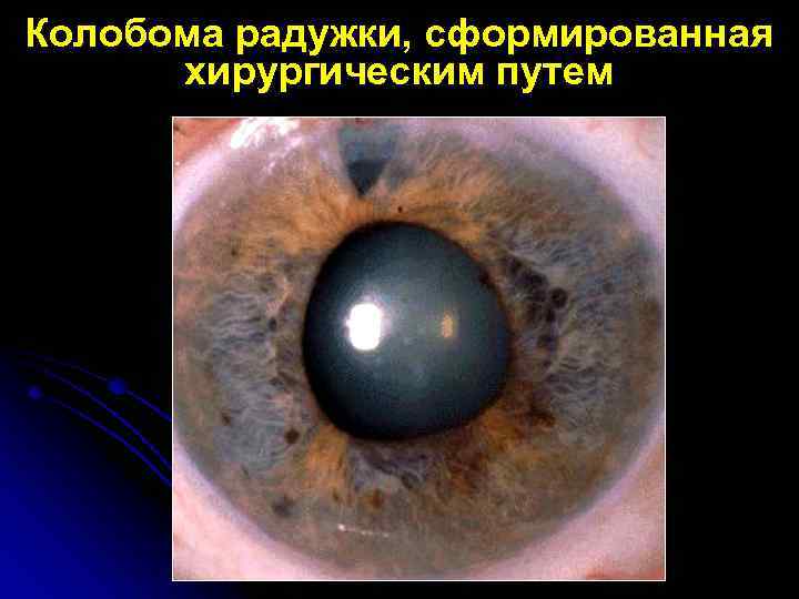 Колобома радужки, сформированная хирургическим путем 