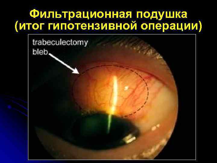 Фильтрационная подушка (итог гипотензивной операции) 