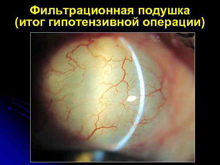 Фильтрационная подушка (итог гипотензивной операции) 
