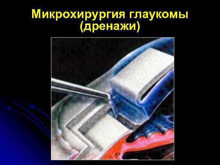 Микрохирургия глаукомы (дренажи) 