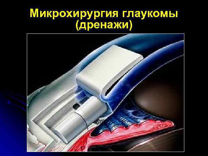 Микрохирургия глаукомы (дренажи) 