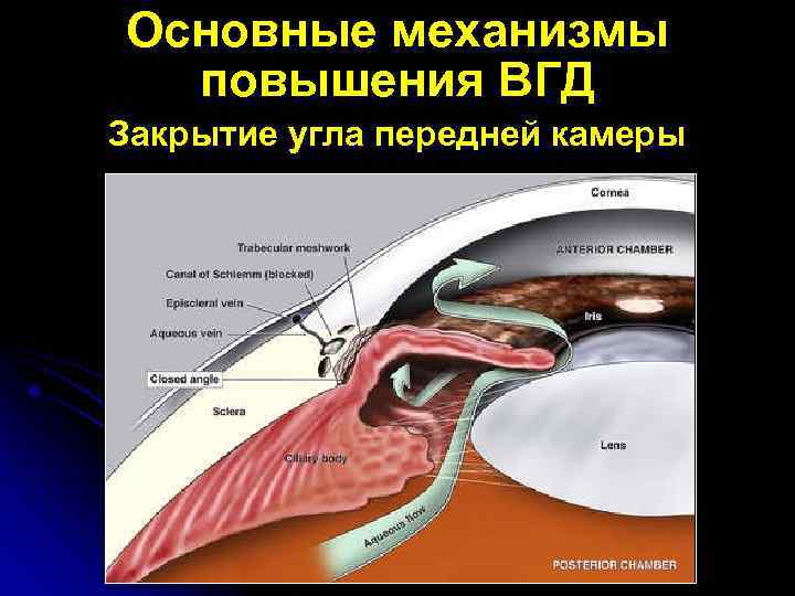 Основные механизмы повышения ВГД Закрытие угла передней камеры 